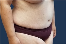 Tummy Tuck After Photo by Noel Natoli, MD, FACS; East Hills, NY - Case 43339