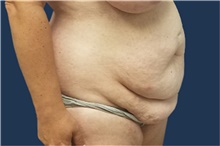 Tummy Tuck Before Photo by Noel Natoli, MD, FACS; East Hills, NY - Case 43339