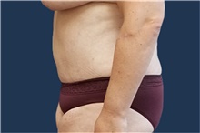 Tummy Tuck After Photo by Noel Natoli, MD, FACS; East Hills, NY - Case 43339