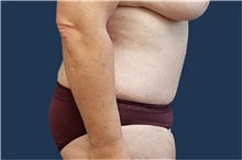 Tummy Tuck After Photo by Noel Natoli, MD, FACS; East Hills, NY - Case 43339