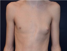 Male Breast Reduction Before Photo by Rachel Ruotolo, MD; Garden City, NY - Case 43383