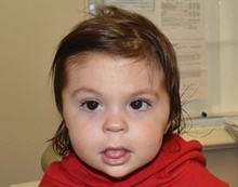 Craniosynostosis After Photo by Rachel Ruotolo, MD; Garden City, NY - Case 43401