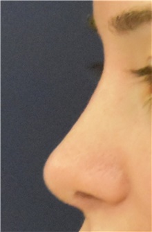 Rhinoplasty After Photo by Richard Reish, MD, FACS; New York, NY - Case 43482