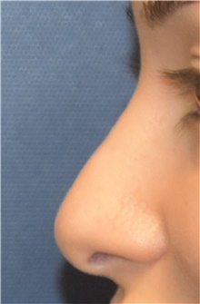 Rhinoplasty Before Photo by Richard Reish, MD, FACS; New York, NY - Case 43482