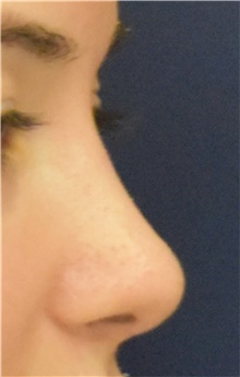 Rhinoplasty After Photo by Richard Reish, MD, FACS; New York, NY - Case 43482