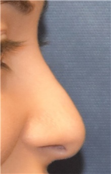 Rhinoplasty Before Photo by Richard Reish, MD, FACS; New York, NY - Case 43482