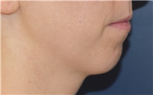 Chin Augmentation Before Photo by Richard Reish, MD, FACS; New York, NY - Case 43501