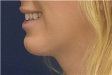 Chin Augmentation After Photo by Richard Reish, MD, FACS; New York, NY - Case 43501