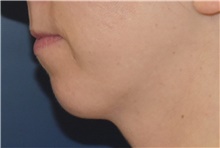 Chin Augmentation Before Photo by Richard Reish, MD, FACS; New York, NY - Case 43501