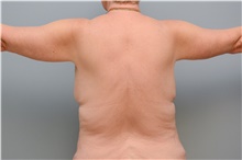 Body Contouring After Photo by Carlos Rivera-Serrano, MD; Bay Harbour Islands, FL - Case 43629