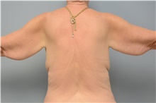 Body Contouring Before Photo by Carlos Rivera-Serrano, MD; Bay Harbour Islands, FL - Case 43629