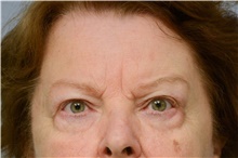 Botulinum Toxin Before Photo by Carlos Rivera-Serrano, MD; Bay Harbour Islands, FL - Case 43630