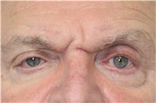 Botulinum Toxin Before Photo by Carlos Rivera-Serrano, MD; Bay Harbour Islands, FL - Case 43631