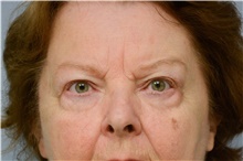 Brow Lift Before Photo by Carlos Rivera-Serrano, MD; Bay Harbour Islands, FL - Case 43664