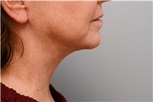 Chin Augmentation After Photo by Carlos Rivera-Serrano, MD; Bay Harbour Islands, FL - Case 43671