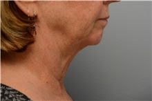 Chin Augmentation Before Photo by Carlos Rivera-Serrano, MD; Bay Harbour Islands, FL - Case 43671