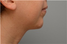 Chin Augmentation After Photo by Carlos Rivera-Serrano, MD; Bay Harbour Islands, FL - Case 43672