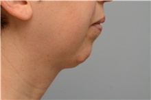 Chin Augmentation Before Photo by Carlos Rivera-Serrano, MD; Bay Harbour Islands, FL - Case 43672