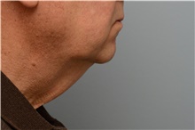 Chin Augmentation Before Photo by Carlos Rivera-Serrano, MD; Bay Harbour Islands, FL - Case 43673