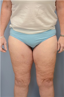 Thigh Lift After Photo by Carlos Rivera-Serrano, MD; Bay Harbour Islands, FL - Case 43747