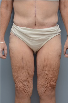 Thigh Lift Before Photo by Carlos Rivera-Serrano, MD; Bay Harbour Islands, FL - Case 43747