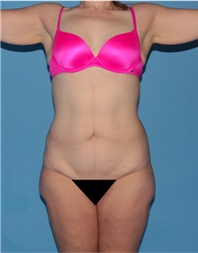 Body Lift Before Photo by Siamak Agha, MD PhD FACS; Newport Beach, CA - Case 43860