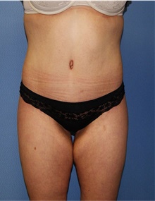 Body Lift After Photo by Siamak Agha, MD PhD FACS; Newport Beach, CA - Case 43876