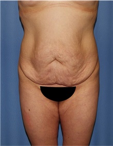 Body Lift Before Photo by Siamak Agha, MD PhD FACS; Newport Beach, CA - Case 43876