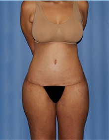 Body Lift After Photo by Siamak Agha, MD PhD FACS; Newport Beach, CA - Case 43877