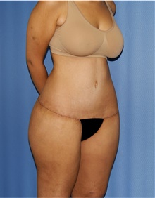 Body Lift After Photo by Siamak Agha, MD PhD FACS; Newport Beach, CA - Case 43877