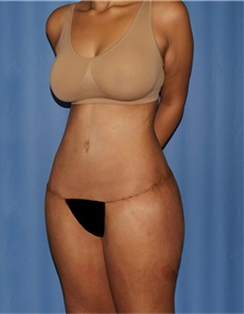 Body Lift After Photo by Siamak Agha, MD PhD FACS; Newport Beach, CA - Case 43877