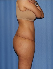 Body Lift After Photo by Siamak Agha, MD PhD FACS; Newport Beach, CA - Case 43877