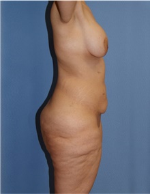 Body Lift Before Photo by Siamak Agha, MD PhD FACS; Newport Beach, CA - Case 43877