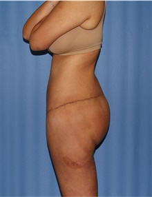 Body Lift After Photo by Siamak Agha, MD PhD FACS; Newport Beach, CA - Case 43877