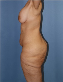 Body Lift Before Photo by Siamak Agha, MD PhD FACS; Newport Beach, CA - Case 43877