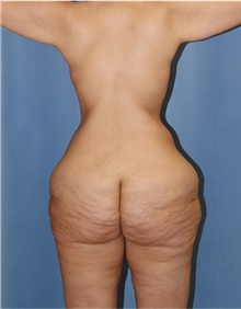 Body Lift Before Photo by Siamak Agha, MD PhD FACS; Newport Beach, CA - Case 43877