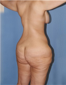 Body Lift Before Photo by Siamak Agha, MD PhD FACS; Newport Beach, CA - Case 43877