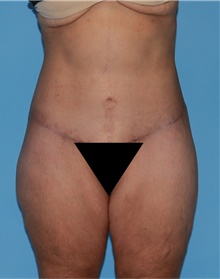 Body Lift After Photo by Siamak Agha, MD PhD FACS; Newport Beach, CA - Case 43879