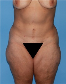 Body Lift Before Photo by Siamak Agha, MD PhD FACS; Newport Beach, CA - Case 43879