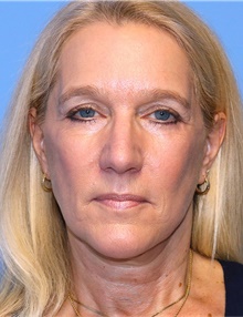 Facelift After Photo by Siamak Agha, MD PhD FACS; Newport Beach, CA - Case 43891