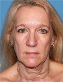 Facelift Before Photo by Siamak Agha, MD PhD FACS; Newport Beach, CA - Case 43891