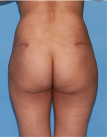 Buttock Lift with Augmentation After Photo by Siamak Agha, MD PhD FACS; Newport Beach, CA - Case 43918