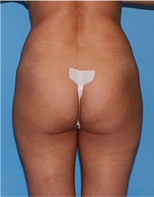 Buttock Lift with Augmentation Before Photo by Siamak Agha, MD PhD FACS; Newport Beach, CA - Case 43918