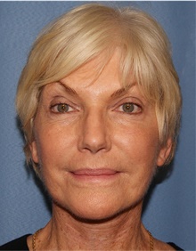 Facelift After Photo by Siamak Agha, MD PhD FACS; Newport Beach, CA - Case 43921