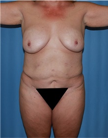 Body Lift Before Photo by Siamak Agha, MD PhD FACS; Newport Beach, CA - Case 43932