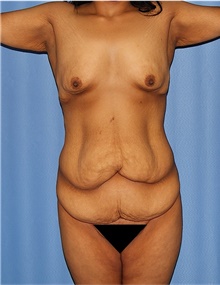 Body Lift Before Photo by Siamak Agha, MD PhD FACS; Newport Beach, CA - Case 43933