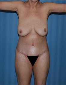 Body Lift After Photo by Siamak Agha, MD PhD FACS; Newport Beach, CA - Case 43934