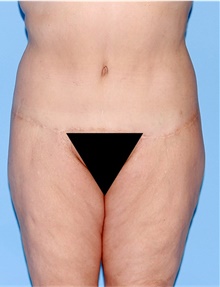 Body Lift After Photo by Siamak Agha, MD PhD FACS; Newport Beach, CA - Case 43943