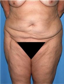 Body Lift Before Photo by Siamak Agha, MD PhD FACS; Newport Beach, CA - Case 43943