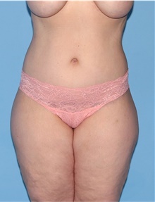 Body Lift After Photo by Siamak Agha, MD PhD FACS; Newport Beach, CA - Case 43946